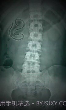 X射线扫描器胃截图1