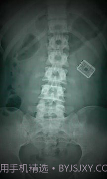 X射线扫描器胃截图3