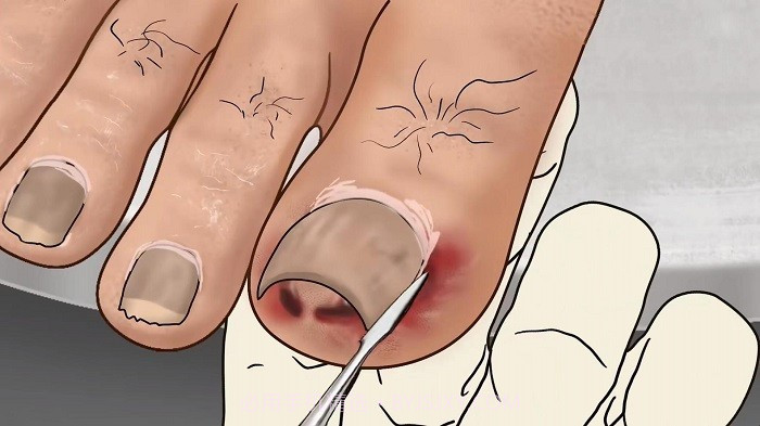 修脚足疔模拟器去更新版截图1